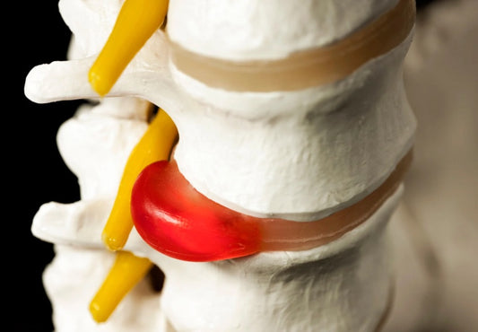 Herniated Disc: Understanding the Condition and Finding Relief