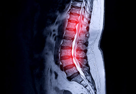 Spinal Stenosis: Understanding the Condition and Finding Relief